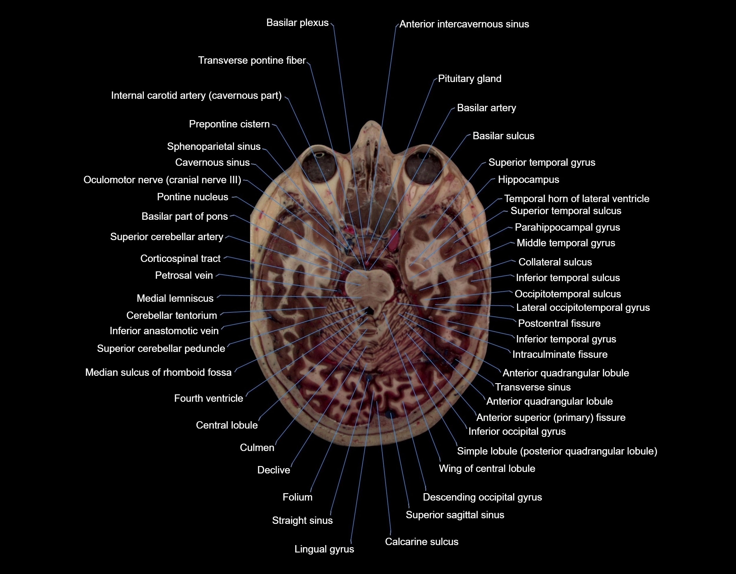 MRI Brain axial cross sectional radiology anatomy 3T image  -img-000029.webp